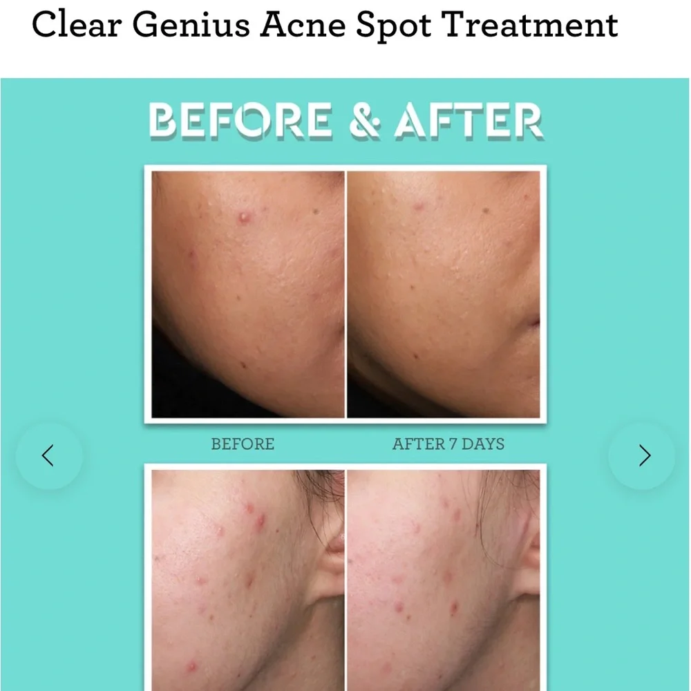 Bliss 2 Clear Genius Acne Spot Treatment * Salicylic Acid Treatment  2 per order - Picture 5 of 5